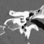 Axial CT scan showing pars tensa cholesteatoma growing medially to ossicular chain in chronic middle ear inflammation