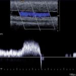 Competent superficial vein