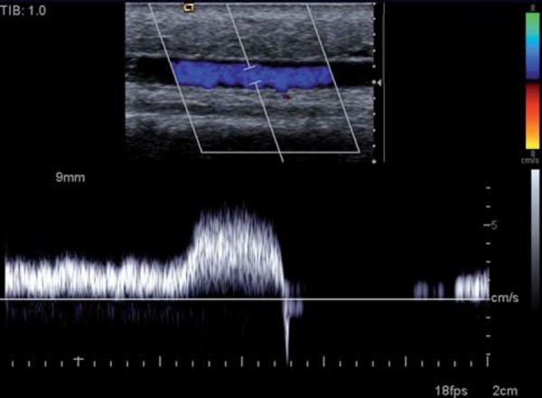 Competent superficial vein