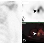 Planar and SPECT/CT images of spondylolysis