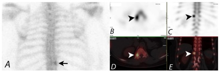 Planar and SPECT/CT images of spondylolysis