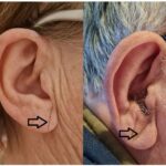 Diagonal Earlobe Crease (Frank's Sign)