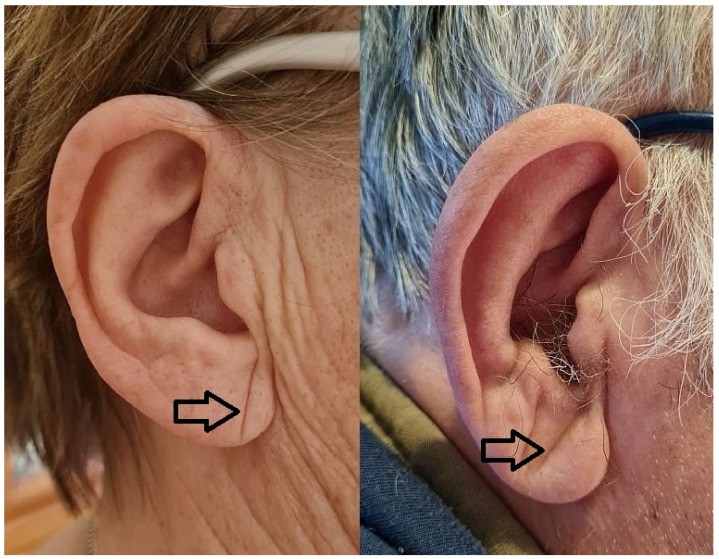 Diagonal Earlobe Crease (Frank's Sign)